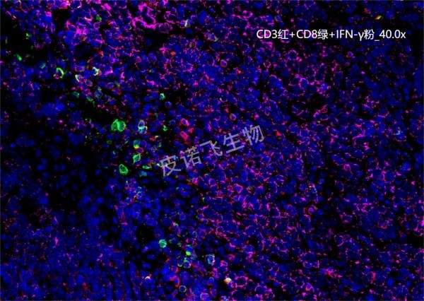 CD3红+CD8绿+IFN-γ粉 肿瘤
