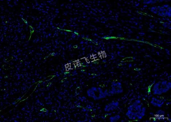CD31绿 肿瘤